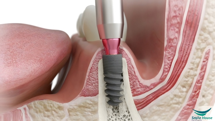 مميزات زرع الأسنان بالخلايا الجذعية