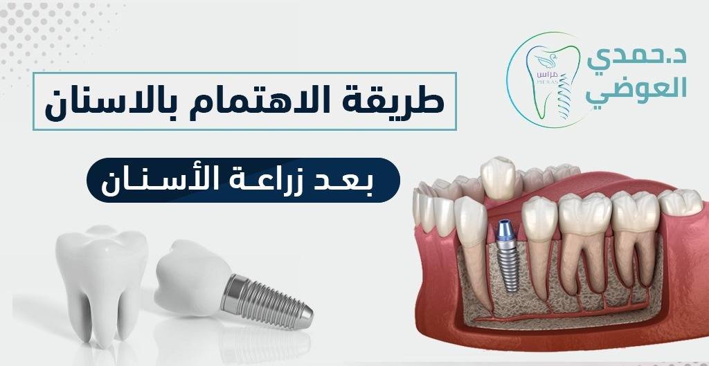 طريقة الاهتمام بالأسنان بعد زراعة الأسنان