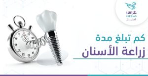 كم تبلغ مدة زراعة الأسنان