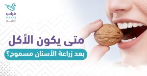 متى يكون الأكل بعد زراعة الأسنان مسموح
