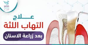 علاج التهاب اللثة بعد زراعة الأسنان