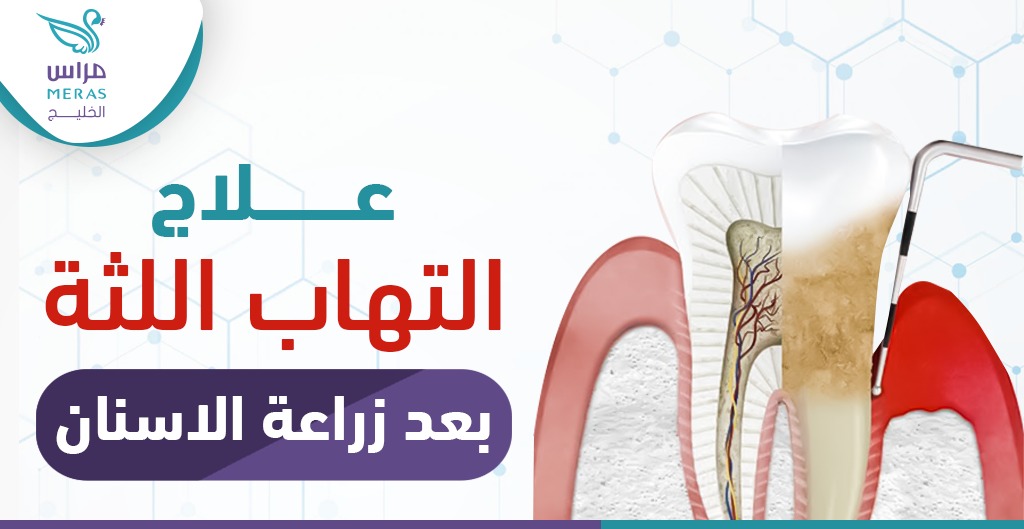 علاج التهاب اللثة بعد زراعة الأسنان والأعراض وطرق العلاج