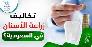 تكاليف زراعة الأسنان في السعودية