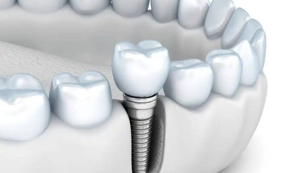 نصائح مهمة بعد إجراء زراعة الأسنان بدون جراحة