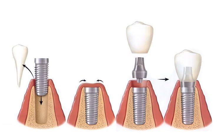 مقدمة عن أهمية فهم مراحل زراعة الأسنان